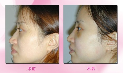 隆鼻手术做得再好也经不住瞎折腾,各种隆鼻手术方法究竟孰优孰劣