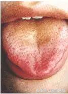 中医舌诊图谱100例,靠谱中医史上最全高清舌诊图谱