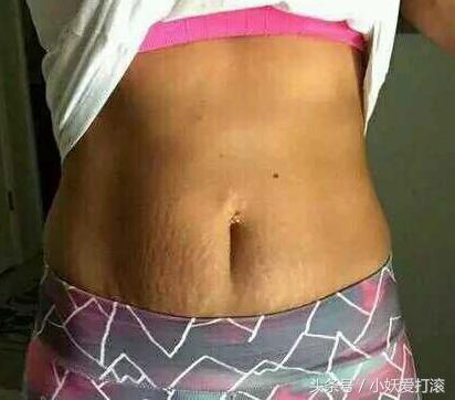 屁股也长妊娠纹,孕中期长妊娠纹用什么祛妊娠纹