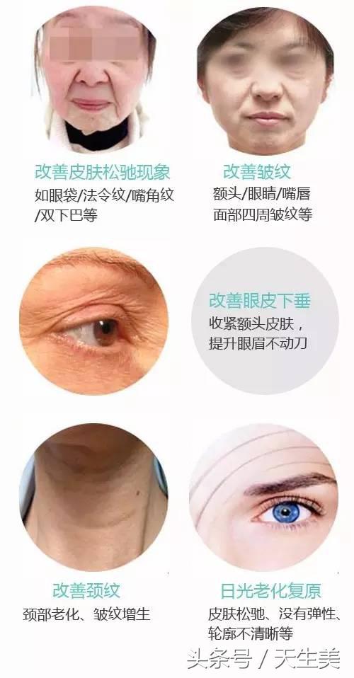 超声刀怎么样啊 (超声刀分享)