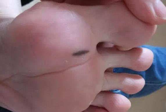 祛痣会引起黑色素瘤,点痣诱发恶性黑色素瘤