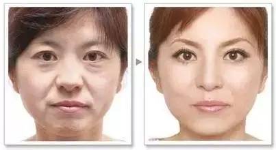 泪沟深怎么办,有了泪沟怎么补救