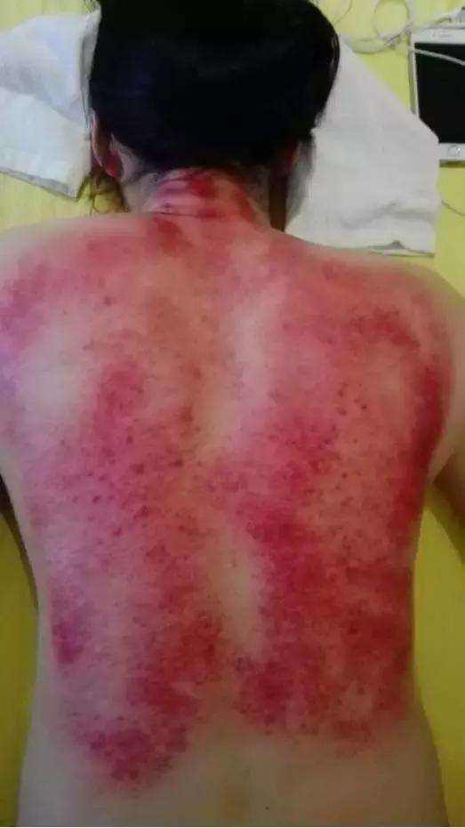 泌乳素39.39能不能治愈,泌乳素偏高中医怎么调