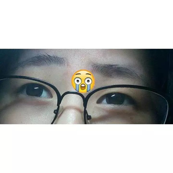 割完双眼皮后眼部吸脂,抽脂双眼皮做完眼睛有褶