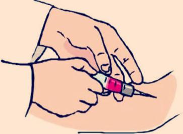 留置针针眼出血要紧吗,抽血后针眼出血