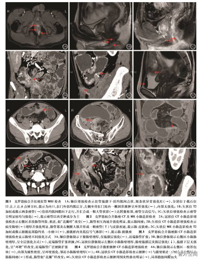 克罗恩病外科并发症的影像学特征