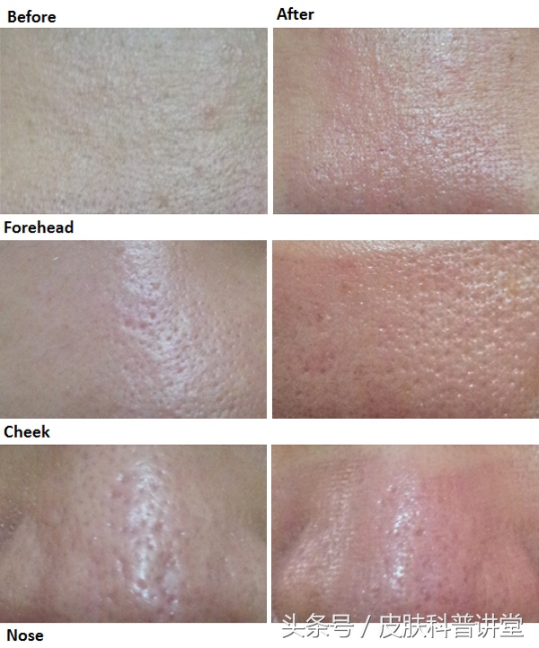 皮肤科医生毛孔粗大推荐的护肤品,毛孔粗大有黑头可以看皮肤科吗