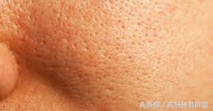 皮肤科医生毛孔粗大推荐的护肤品,毛孔粗大有黑头可以看皮肤科吗