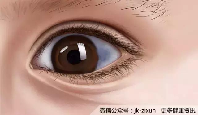眼白上有黑点是怎么回事,眼白上的黑斑有影响吗