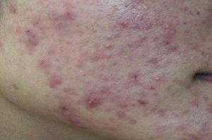 B超没有多囊，也可能是多囊卵巢综合征！