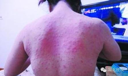 全身发痒是新冠吗怎么治疗,得新冠全身痒