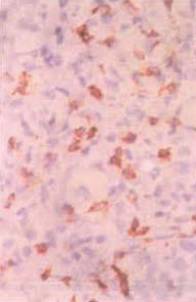 有一种病叫红斑丘疹,边界清晰发痒红斑有丘疹是湿疹吗