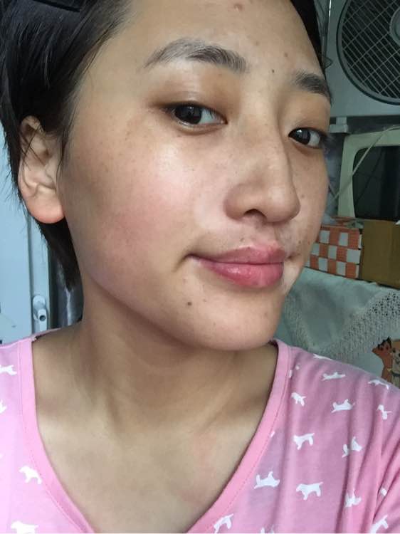 白斑光照,白斑光照后图片