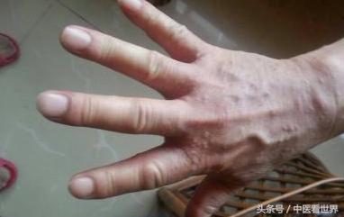 湿疹会传染吗要怎么治,湿疹会反复发作不会传染