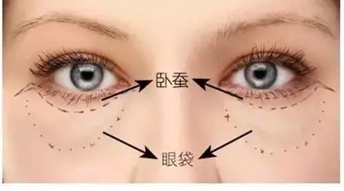 眼袋和卧蚕的区别看完你就知,卧蚕和眼袋的区别你知道吗