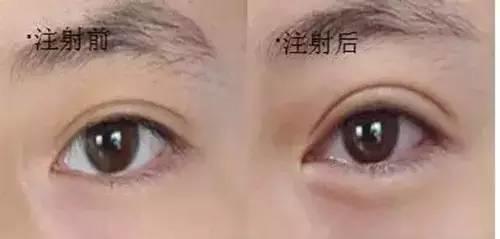 眼袋和卧蚕的区别看完你就知,卧蚕和眼袋的区别你知道吗