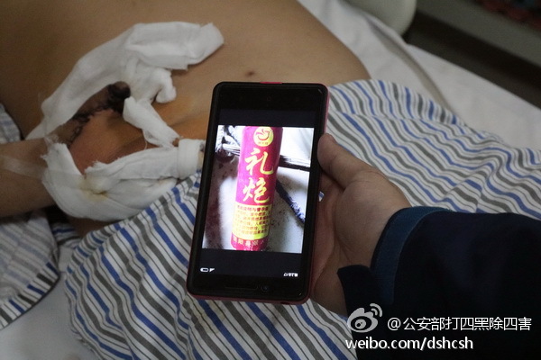 烟花掉下来砸到头,烟花男子右眼被炸伤