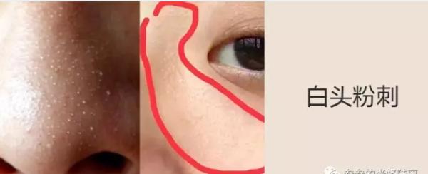 简单又有效的祛黑头方法，今天才是实在的方法