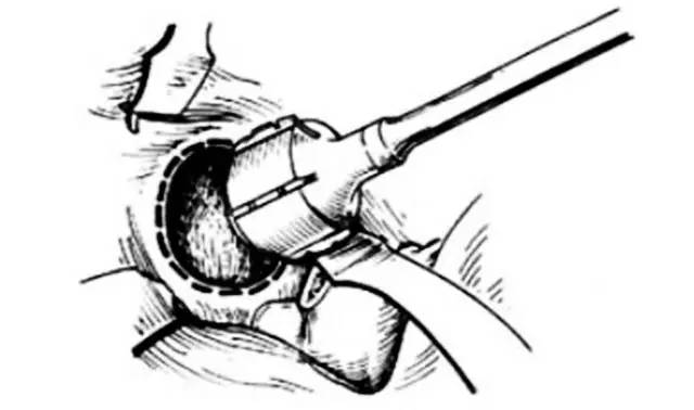 北京积水潭股骨头坏死的治疗方法,北京积水潭专家讲股骨头坏死三期