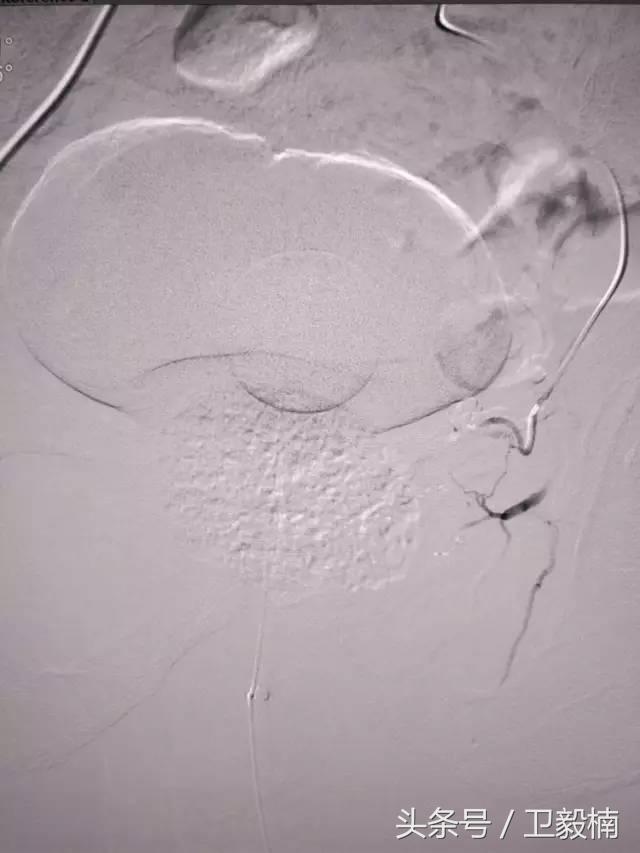 微创介入科一卫毅楠,什么是心血管介入治疗