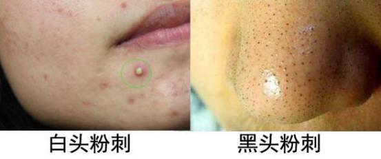 下巴长小丘疹连成片发红结痂,下巴长了密密麻麻的小丘疹怎么办