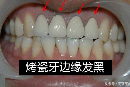 烤瓷牙真的不好吗,被牙医骗了做了烤瓷牙