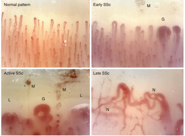 硬皮病是一种什么病,硬皮病由什么造成的