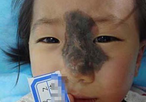 胎记去除特效药,胎记偏方