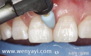 门牙有缝是什么说法,门牙有缝怎么办如何补救