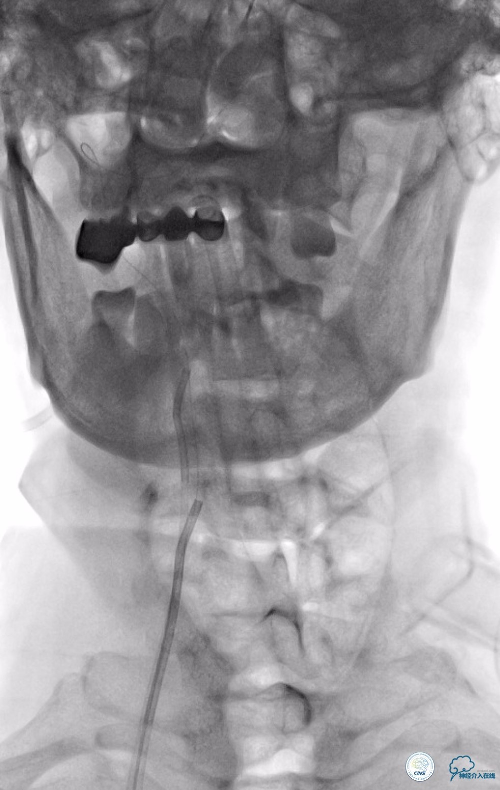天坛周记|基底动脉狭窄合并动脉瘤血管内介入治疗一例