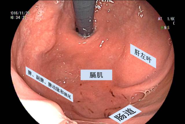 当EUS遇到“假瘤子”(二)——都是“隔壁老王”惹的祸(毗邻外压)