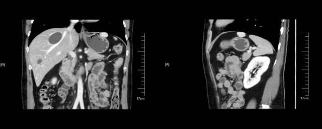当EUS遇到“假瘤子”(二)——都是“隔壁老王”惹的祸(毗邻外压)