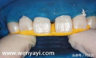 门牙有缝的女人有什么不好,门牙有缝怎么办如何补救