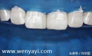 门牙有缝的女人有什么不好,门牙有缝怎么办如何补救