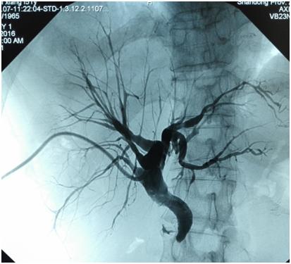 “小引流大作用”救命的胆道外引流管治疗晚期肿瘤性黄疸