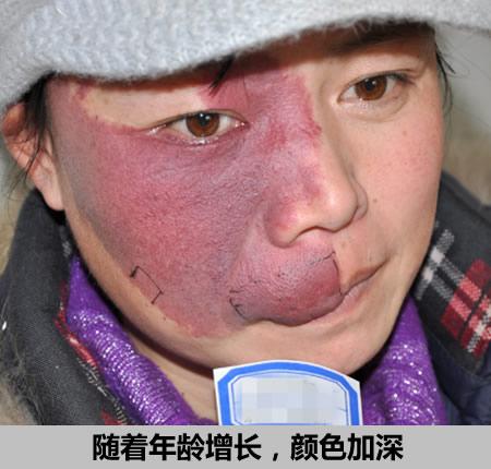 为什么胎记除不了根,为什么胎记不能被别人看见