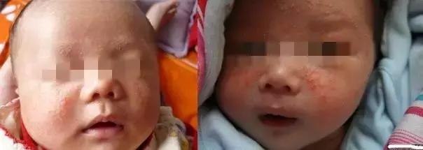 婴儿湿疹和宝妈有关吗,宝宝脸上湿疹宝妈饮食