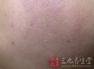 去粉刺的治愈过程放大,粉刺针去除粉刺后有黑印