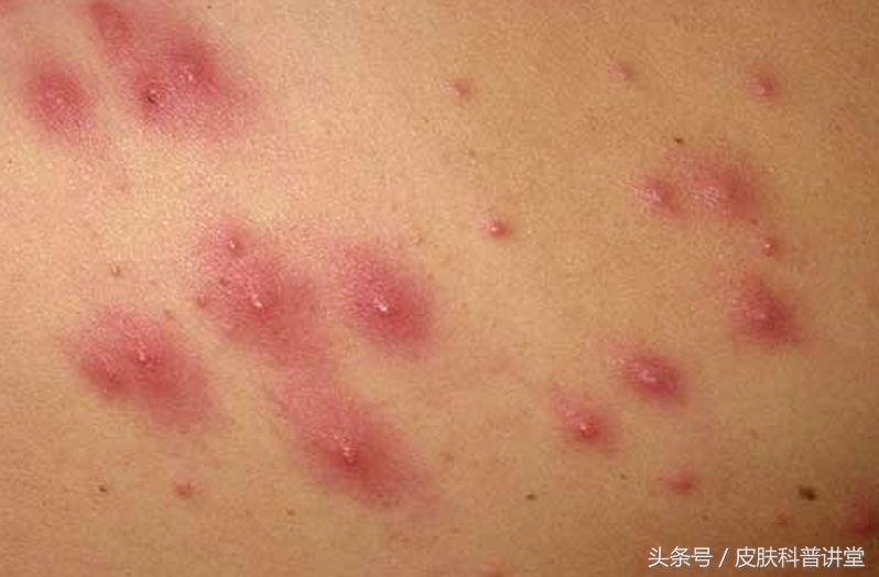 皮肤毛囊炎最简单自愈方法,皮肤科普小讲堂第一讲