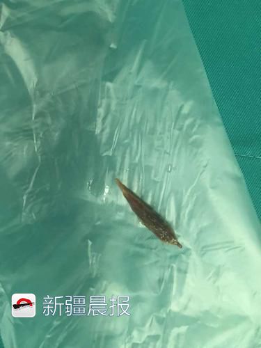 女童误吞枣核致肠穿孔,宝宝吞了红枣核肠穿孔几率