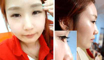 韩式隆鼻因为“韩式”价格翻番,汇总你都踩过多少坑?