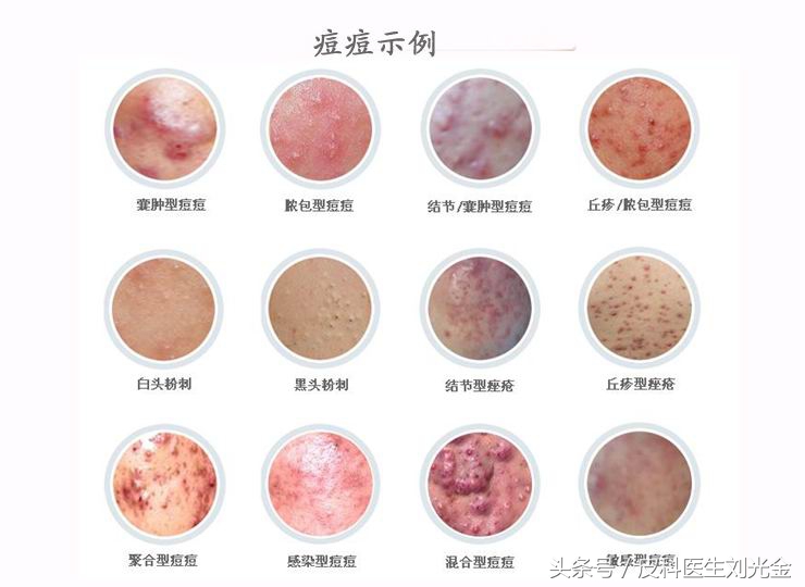 脸上长痘疮的快速解决方法,读懂此文你就可以远离亏损了