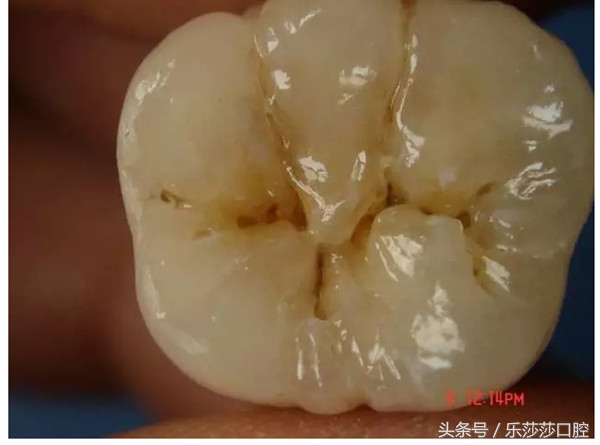 大牙上有黑线是怎么回事,孩子大牙上有黑线怎么办