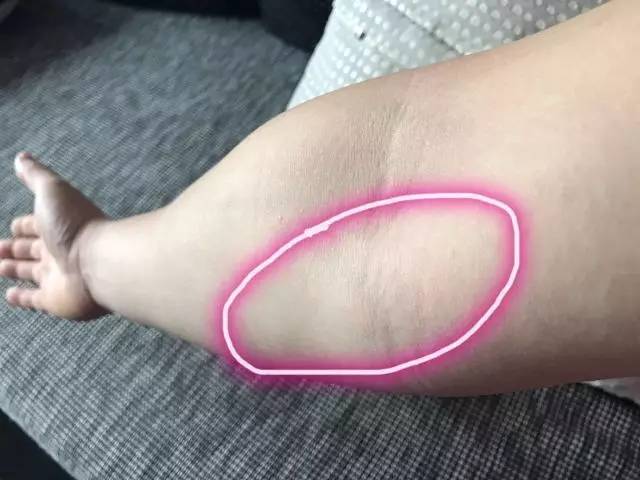 髌骨软骨软化的康复训练,髌骨软化如何讲解