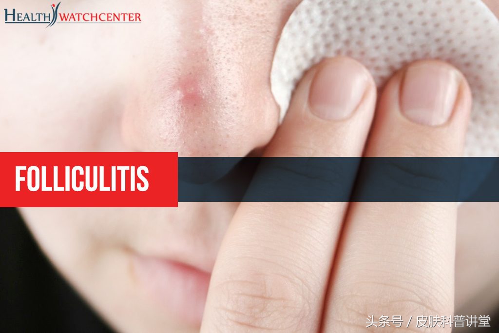 皮肤科普健康知识讲座,皮肤病种类图毛囊炎