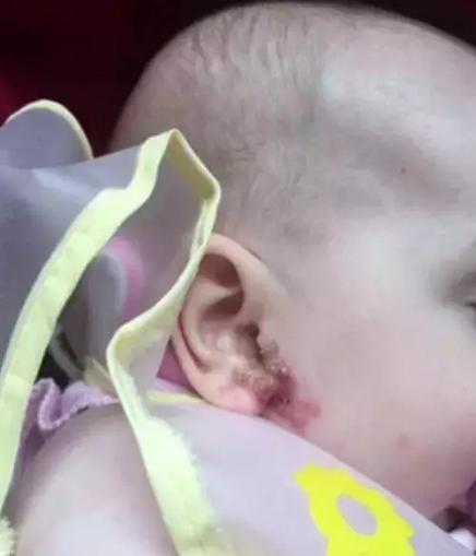 捂热综合症患儿死亡,八岁孩子捂热综合征