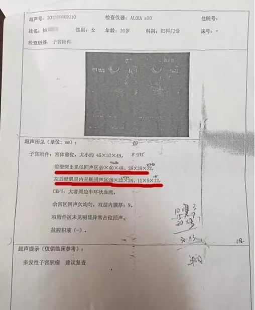 肌瘤消除方法,肌瘤消融疗法