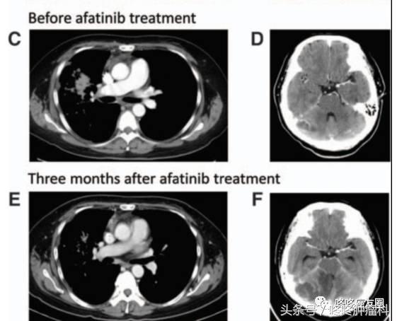 肺腺癌基因种类和相对应的靶向药,肺癌基因没有突变靶向药有效果吗