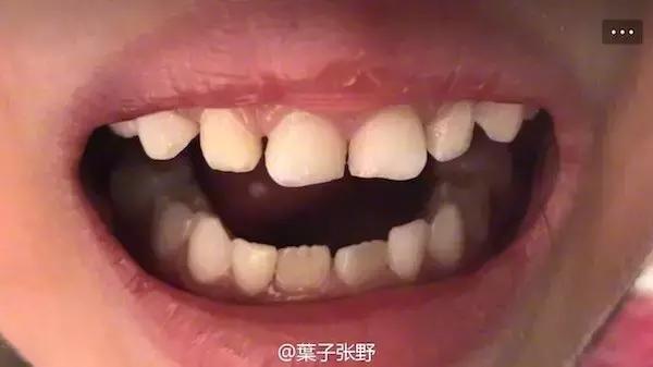 孩子的牙黑怎么办,孩子换过的牙又黄又黑