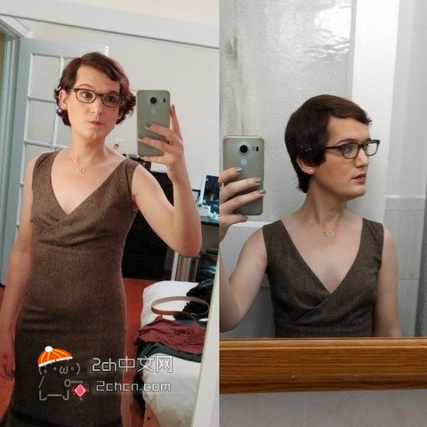 秃头大叔服用雌性激素,秃头男吃雌激素一年